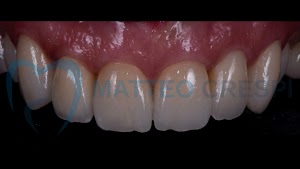 Faccette Dentali - Dr. Matteo Crespi